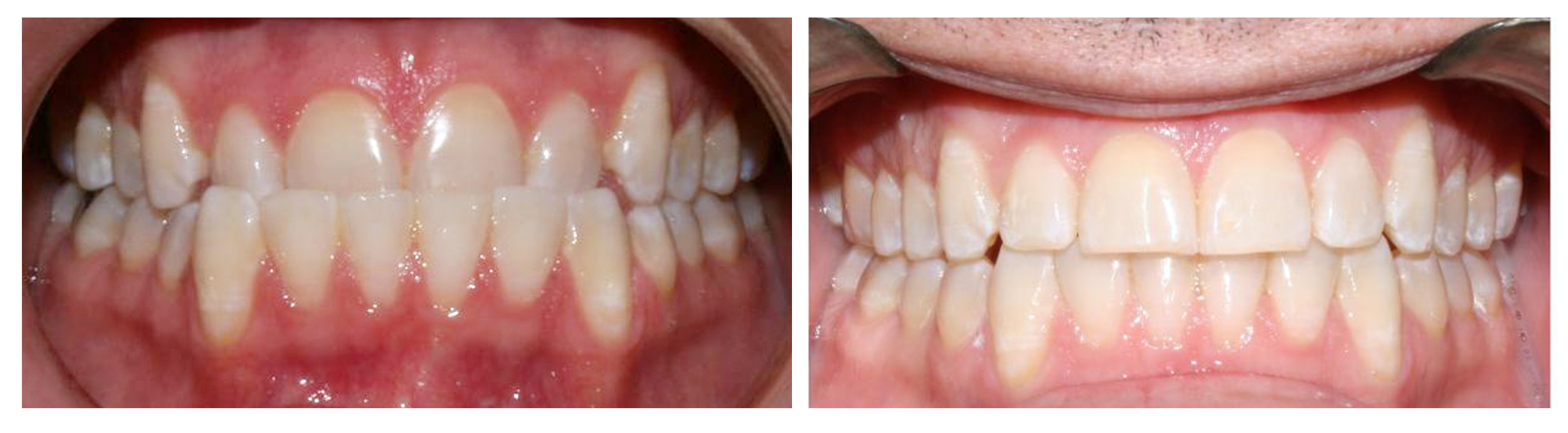 Before and After Invisalign treatment